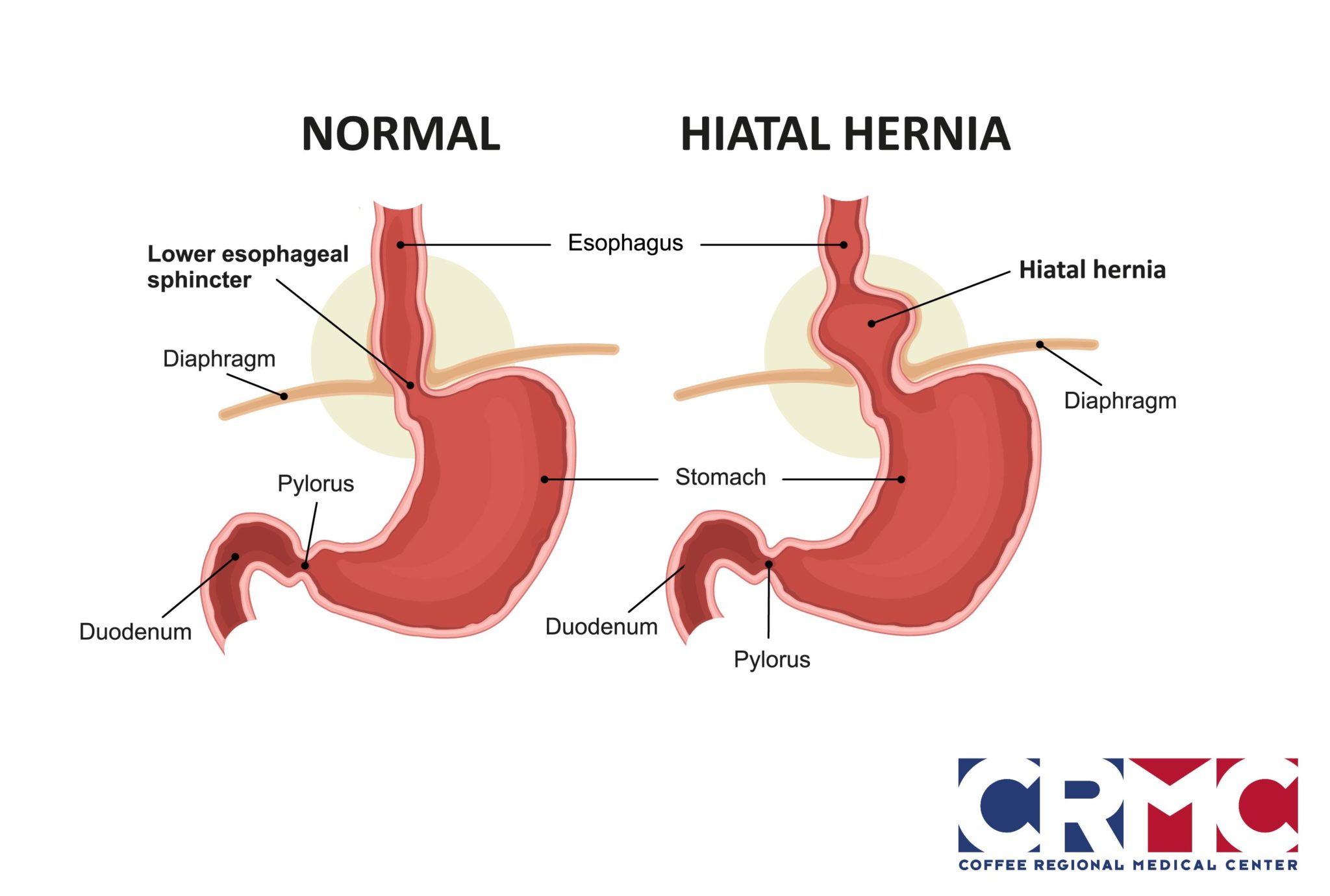 Could A Hiatal Hernia Be Causing Your Reflux Coffee Regional Medical could-a-hiatal-hernia-be-causing-your-reflux-coffee-regional-medical