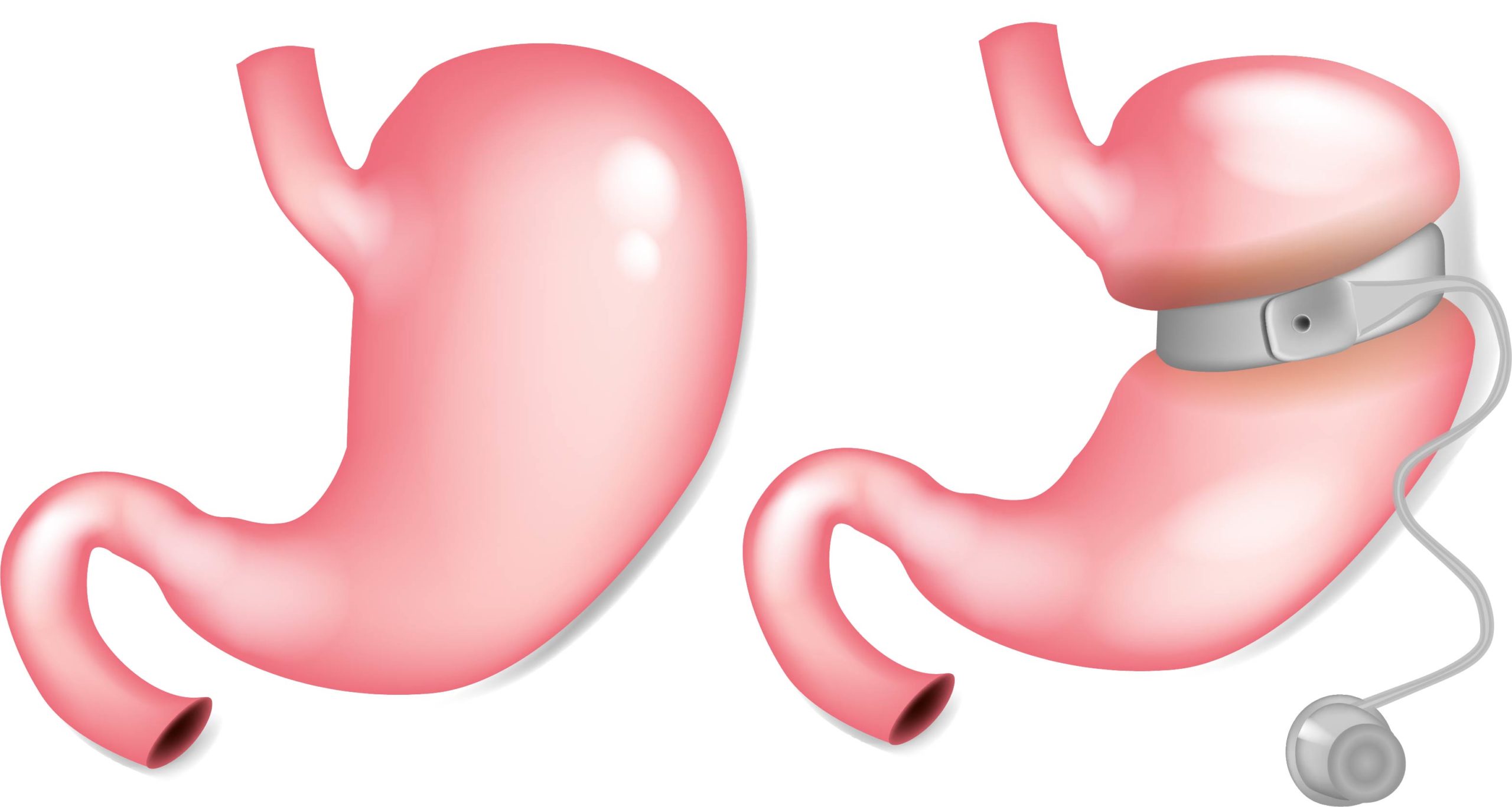 gastric banding image Coffee Regional Medical Center